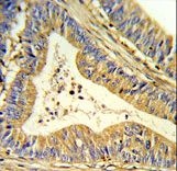 Formalin-fixed and paraffin-embedded human colon carcinoma reacted with SOD1 Antibody , which was peroxidase-conjugated to the secondary antibody, followed by DAB staining. This data demonstrates the use of this antibody for immunohistochemistry; clinical relevance has not been evaluated.