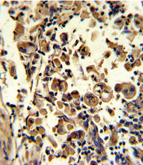 Formalin-fixed and paraffin-embedded human lung carcinoma reacted with SOD3 Antibody , which was peroxidase-conjugated to the secondary antibody, followed by DAB staining. This data demonstrates the use of this antibody for immunohistochemistry; clinical relevance has not been evaluated.