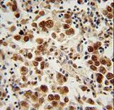 SOHLH1 Antibody immunohistochemistry of formalin-fixed and paraffin-embedded human testis carcinoma followed by peroxidase-conjugated secondary antibody and DAB staining.