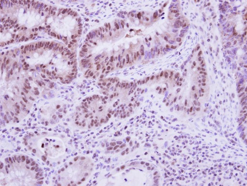 IHC of paraffin-embedded Colon ca, using Vinexin antibody at 1:250 dilution.
