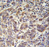 ANKRD57 Antibody immunohistochemistry of formalin-fixed and paraffin-embedded human cervix carcinoma followed by peroxidase-conjugated secondary antibody and DAB staining.