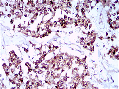 IHC of paraffin-embedded breast cancer tissues using SOX10 mouse monoclonal antibody with DAB staining.