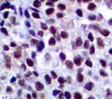 IHC of Cytokeratin SOX-10 on FFPE Melanoma tissue.