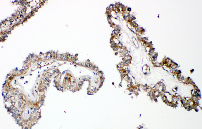 PTHR / PTHR1 antibody. IHC(P): Human Thyroid Cancer Tissue.