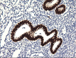IHC of paraffin-embedded Adenocarcinoma of breast tissue using anti-SOX17 mouse monoclonal antibody. (Dilution 1:50).