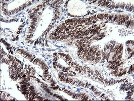 IHC of paraffin-embedded Adenocarcinoma of ovary tissue using anti-SOX17 mouse monoclonal antibody. (Dilution 1:50).
