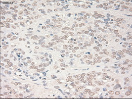 IHC of paraffin-embedded Carcinoma of bladder tissue using anti-SOX17 mouse monoclonal antibody. (Dilution 1:50).