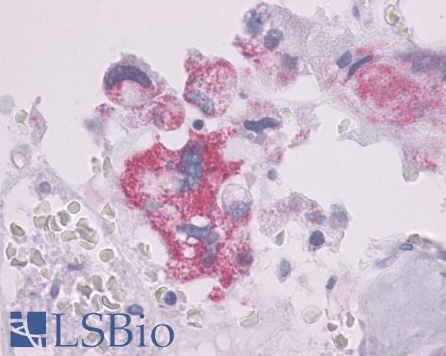 Anti-PTHR / PTHR1 antibody IHC of human Bone, Giant Cell Tumor. Immunohistochemistry of formalin-fixed, paraffin-embedded tissue after heat-induced antigen retrieval.