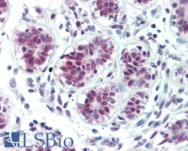 Anti-SOX4 antibody IHC of human breast. Immunohistochemistry of formalin-fixed, paraffin-embedded tissue after heat-induced antigen retrieval. Antibody LS-B3370 concentration 15 ug/ml.