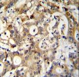 SP1 Antibody (C-term P692) immunohistochemistry of formalin-fixed and paraffin-embedded human colon carcinoma followed by peroxidase-conjugated secondary antibody and DAB staining.