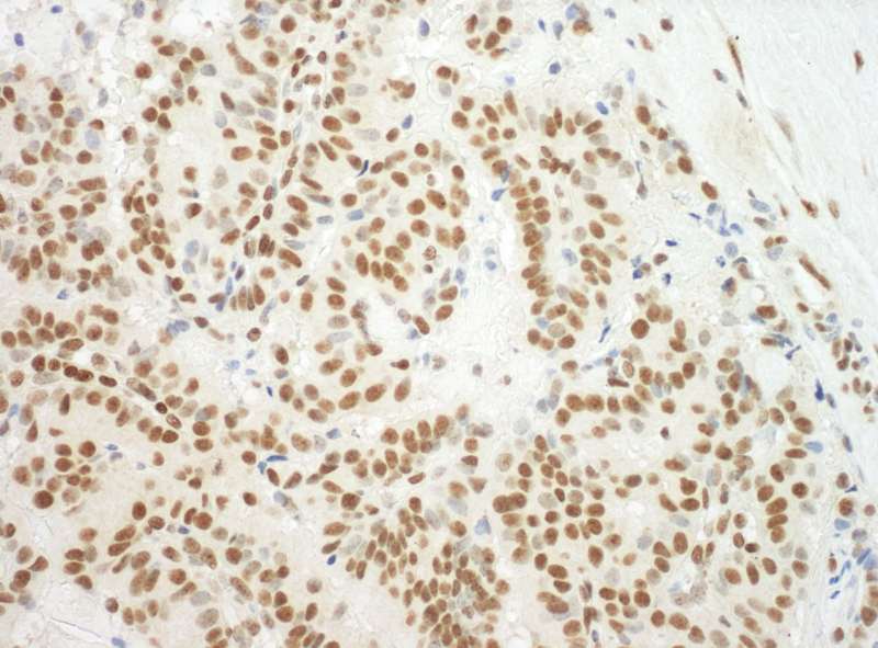 Detection of Human Sp3 by Immunohistochemistry. Sample: FFPE section of human breast carcinoma. Antibody: Affinity purified rabbit anti-Sp3 used at a dilution of 1:1000 (1 ug/ml). Detection: DAB.