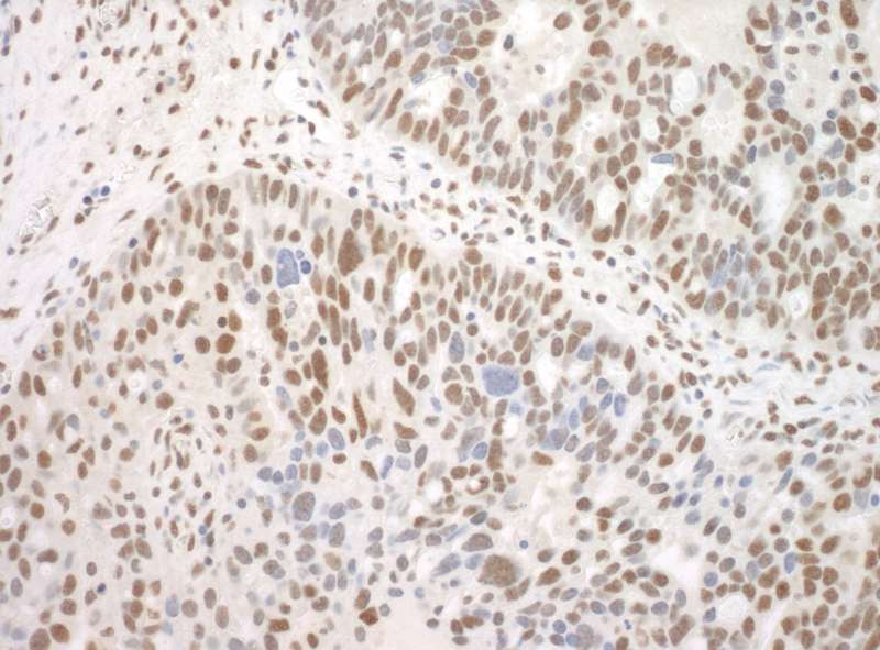 Detection of Human Sp3 by Immunohistochemistry. Sample: FFPE section of human ovarian carcinoma. Antibody: Affinity purified rabbit anti-Sp3 used at a dilution of 1:100.
