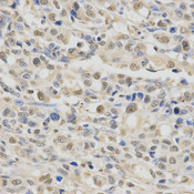 Immunohistochemistry of paraffin-embedded human stomach cancer using SPHK1 antibody at dilution of 1:200 (x400 lens).