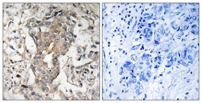 IHC of paraffin-embedded human breast carcinoma tissue, using SPHK2 (Ab-614) Antibody. The picture on the right is treated with the synthesized peptide.