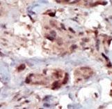 Formalin-fixed and paraffin-embedded human cancer tissue reacted with the primary antibody, which was peroxidase-conjugated to the secondary antibody, followed by AEC staining. This data demonstrates the use of this antibody for immunohistochemistry; clinical relevance has not been evaluated. BC = breast carcinoma; HC = hepatocarcinoma.