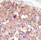 Formalin-fixed and paraffin-embedded human cancer tissue reacted with the primary antibody, which was peroxidase-conjugated to the secondary antibody, followed by AEC staining. This data demonstrates the use of this antibody for immunohistochemistry; clinical relevance has not been evaluated. BC = breast carcinoma; HC = hepatocarcinoma.