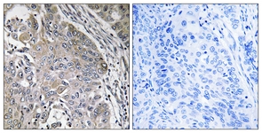 IHC of paraffin-embedded human lung carcinoma, using SPINK6 Antibody. The picture on the right is treated with the synthesized peptide.