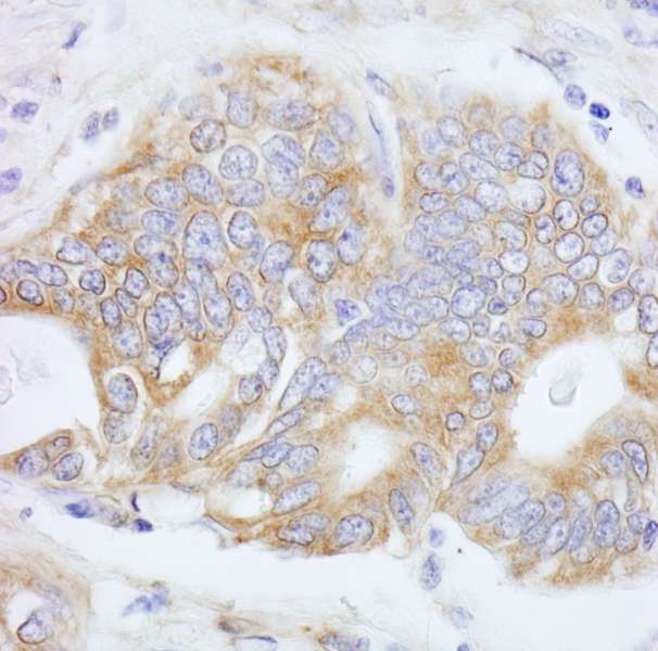 Detection of Human PTPN12/PTP-PEST by Immunohistochemistry. Sample: FFPE section of human stomach carcinoma. Antibody: Affinity purified rabbit anti-PTPN12/PTP-PEST used at a dilution of 1:200 (1 ug/ml). Detection: DAB.