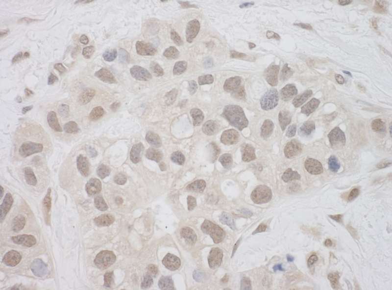 Detection of Human SUPT7L by Immunohistochemistry. Sample: FFPE section of human breast carcinoma. Antibody: Affinity purified rabbit anti-SUPT7L used at a dilution of 1:200 (1 ug/mg).