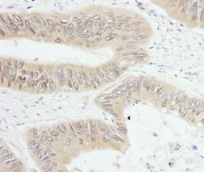Detection of Human PTPN12/PTP-PEST by Immunohistochemistry. Sample: FFPE section of human colon carcinoma. Antibody: Affinity purified rabbit anti-PTPN12/PTP-PEST used at a dilution of 1:200 (1 ug/ml). Detection: DAB.