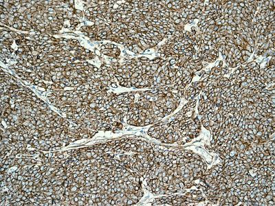 IHC of paraffin-embedded human breast carcinoma tissue using anti-Alpha Fodrin antibody.