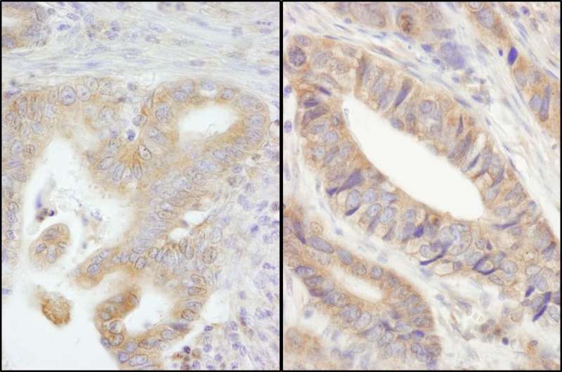 Detection of Human PTPN12/PTP-PEST by Immunohistochemistry. Sample: FFPE section of human stomach carcinoma (left) and colon carcinoma (right). Antibody: Affinity purified rabbit anti-PTPN12/PTP-PEST used at a dilution of 1:200 (1 ug/ml). Detection: DAB.