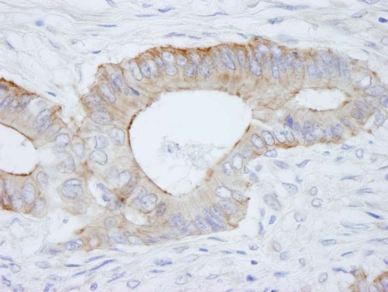 Detection of Human SPTBN1 by Immunohistochemistry. Sample: FFPE section of human colon adenocarcinoma. Antibody: Affinity purified rabbit anti-SPTBN1 used at a dilution of 1:250.