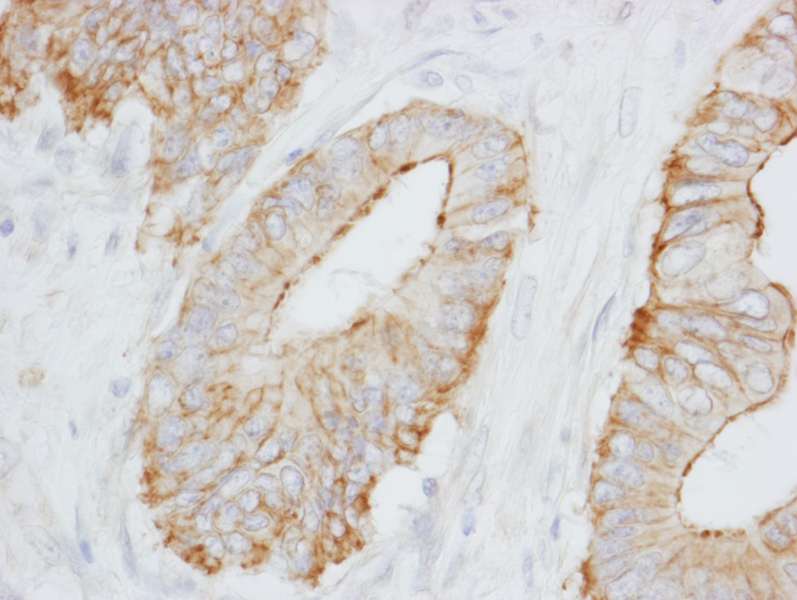 Detection of Human SPTBN1 by Immunohistochemistry. Sample: FFPE section of human colon carcinoma. Antibody: Affinity purified rabbit anti-SPTBN1 used at a dilution of 1:1000 (0.2 ug/ml). Detection: DAB.