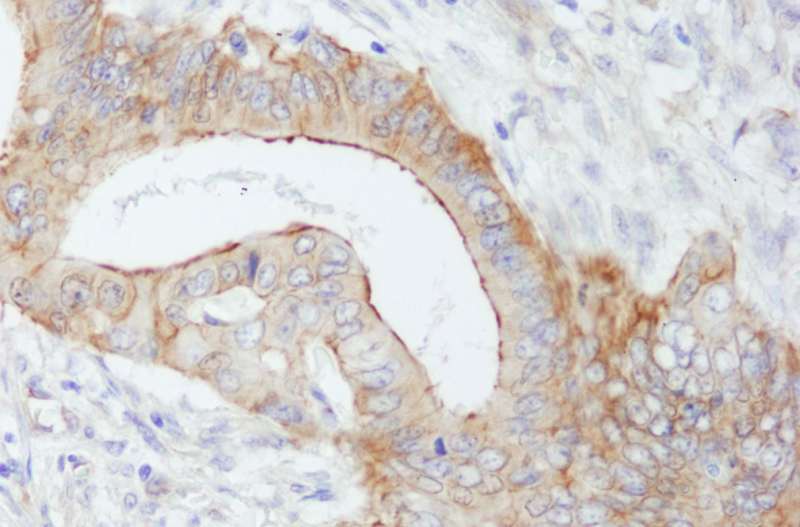 Detection of Human SPTBN1 by Immunohistochemistry. Sample: FFPE section of human colon carcinoma. Antibody: Affinity purified rabbit anti-SPTBN1 used at a dilution of 1:1000 (0.2 ug/ml). Detection: DAB.