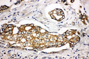 SPTLC1 / HSN1 antibody. IHC(P): Human Breast Cancer Tissue.