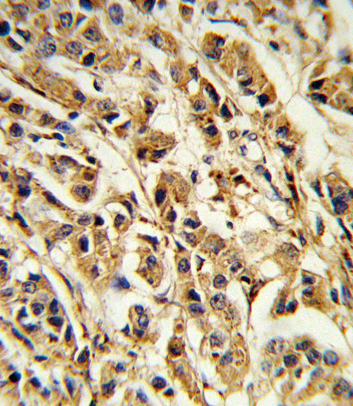 Formalin-fixed and paraffin-embedded human breast carcinoma reacted with SREBF1 Antibody , which was peroxidase-conjugated to the secondary antibody, followed by DAB staining. This data demonstrates the use of this antibody for immunohistochemistry; clinical relevance has not been evaluated.
