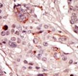 Formalin-fixed and paraffin-embedded human cancer tissue reacted with the primary antibody, which was peroxidase-conjugated to the secondary antibody, followed by AEC staining. This data demonstrates the use of this antibody for immunohistochemistry; clinical relevance has not been evaluated. BC = breast carcinoma; HC = hepatocarcinoma.