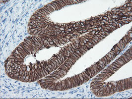 IHC of paraffin-embedded Adenocarcinoma of Human endometrium tissue using anti-SRPRB mouse monoclonal antibody.