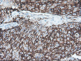 IHC of paraffin-embedded Carcinoma of Human bladder tissue using anti-SRPRB mouse monoclonal antibody.