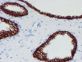 IHC of paraffin-embedded Carcinoma of Human prostate tissue using anti-SRPRB mouse monoclonal antibody.