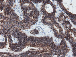 IHC of paraffin-embedded Adenocarcinoma of Human colon tissue using anti-SRPRB mouse monoclonal antibody.