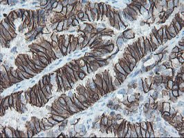 IHC of paraffin-embedded Adenocarcinoma of Human ovary tissue using anti-SRPRB mouse monoclonal antibody.