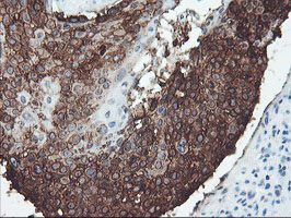IHC of paraffin-embedded Carcinoma of Human lung tissue using anti-SRPRB mouse monoclonal antibody.