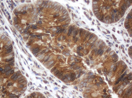 IHC of paraffin-embedded Adenocarcinoma of Human colon tissue using anti-SRPRB mouse monoclonal antibody.