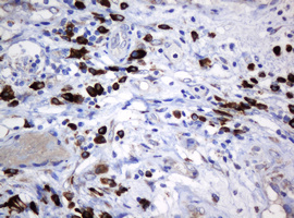 IHC of paraffin-embedded Carcinoma of Human bladder tissue using anti-SRPRB mouse monoclonal antibody.