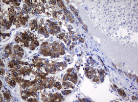 IHC of paraffin-embedded Carcinoma of Human liver tissue using anti-SRPRB mouse monoclonal antibody.