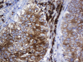 IHC of paraffin-embedded Adenocarcinoma of Human colon tissue using anti-SRPRB mouse monoclonal antibody.