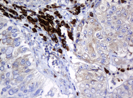 IHC of paraffin-embedded Carcinoma of Human bladder tissue using anti-SRPRB mouse monoclonal antibody. (Heat-induced epitope retrieval by 10mM citric buffer, pH6.0, 120°C for 3min).