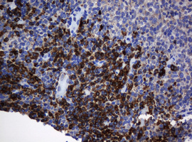 IHC of paraffin-embedded Adenocarcinoma of Human colon tissue using anti-SRPRB mouse monoclonal antibody. (Heat-induced epitope retrieval by 10mM citric buffer, pH6.0, 120°C for 3min).