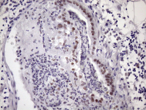 IHC of paraffin-embedded Carcinoma of Human pancreas tissue using anti-SRSF9 mouse monoclonal antibody. (Heat-induced epitope retrieval by Tris-EDTA, pH8.0)(1:150).