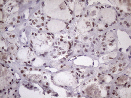 IHC of paraffin-embedded Carcinoma of Human thyroid tissue using anti-SRSF9 mouse monoclonal antibody. (Heat-induced epitope retrieval by Tris-EDTA, pH8.0)(1:150).