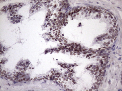 IHC of paraffin-embedded Carcinoma of Human prostate tissue using anti-SRSF9 mouse monoclonal antibody. (Heat-induced epitope retrieval by Tris-EDTA, pH8.0)(1:150).