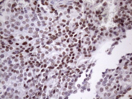IHC of paraffin-embedded Adenocarcinoma of Human breast tissue using anti-SRSF9 mouse monoclonal antibody. (Heat-induced epitope retrieval by Tris-EDTA, pH8.0)(1:150).