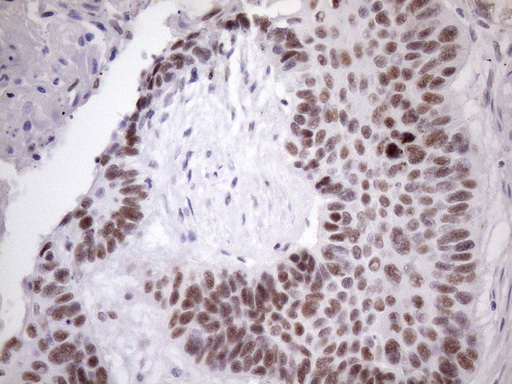 IHC of paraffin-embedded Carcinoma of Human lung tissue using anti-SRSF9 mouse monoclonal antibody. (Heat-induced epitope retrieval by Tris-EDTA, pH8.0)(1:150).