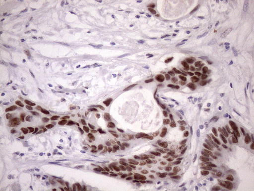 IHC of paraffin-embedded Adenocarcinoma of Human colon tissue using anti-SRSF9 mouse monoclonal antibody. (Heat-induced epitope retrieval by Tris-EDTA, pH8.0)(1:150).
